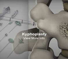 Graphic of Kyphoplasty Treatment for Back Pain