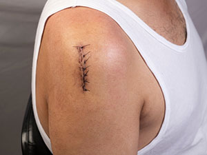 Photo of a man with shoulder sutures after surgery
