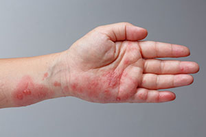 Photo of hand with shingles outbreak