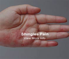 Graphic of Hand With Shingles Pain