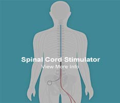 Graphic of Spinal Cord Stimulator Pain Relief