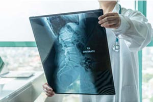 Medical professional reviewing a spine x-ray film 
