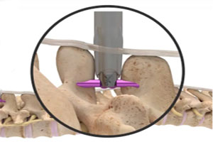 Graphic of Vertiflex Procedure for Lumbar Spinal Stenosis
