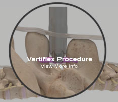 Graphic of Vertiflex Procedure for Lumbar Spinal Stenosis